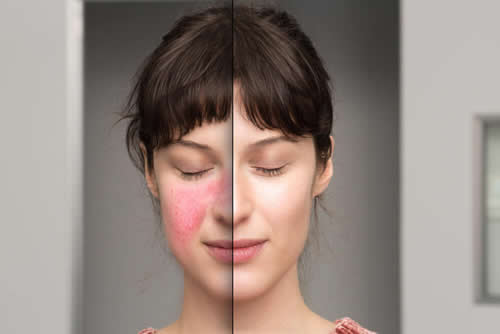 rosacea-before-after-cosmetic-treatment-skin-disorders