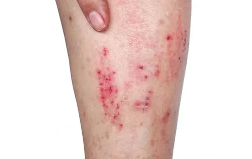 atopic dermatitis on legs