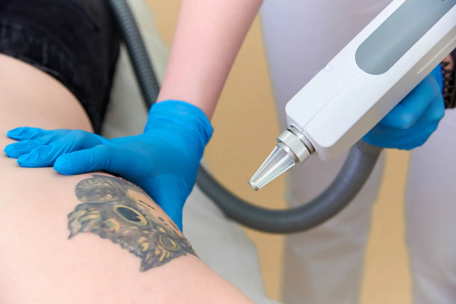 procedure-removal-tattoo-laser-cosmetic-dermatology